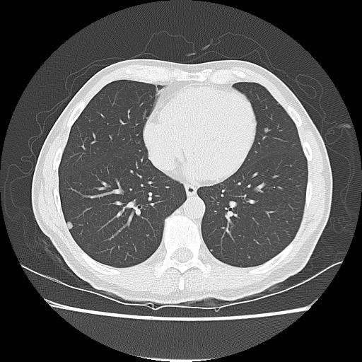 CT Chest Solitary Metastasis